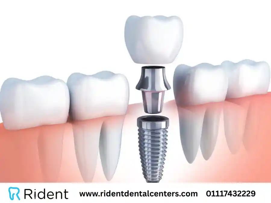 تجربتي مع زراعة الأسنان لـ 5 حالات مختلفة